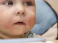 Czerwone policzki u niemowlaka mogą świadczyć o alergii.