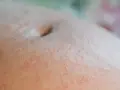 Skóra brzucha z widoczną wysypką, typową dla zmian skórnych w ciąży.